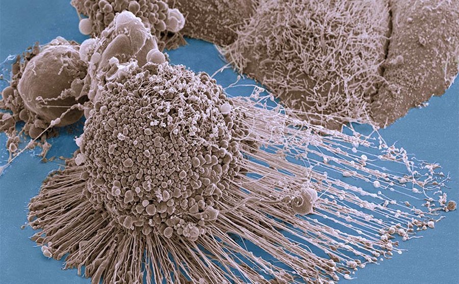 When Cancer Cells Can’t Make Their Own Fat, They Eat What’s Around Them