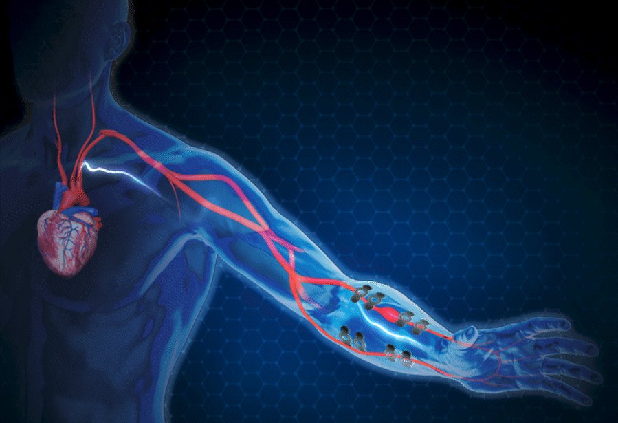 Blood Pressure E-Tattoo Promises Continuous, Mobile Monitoring