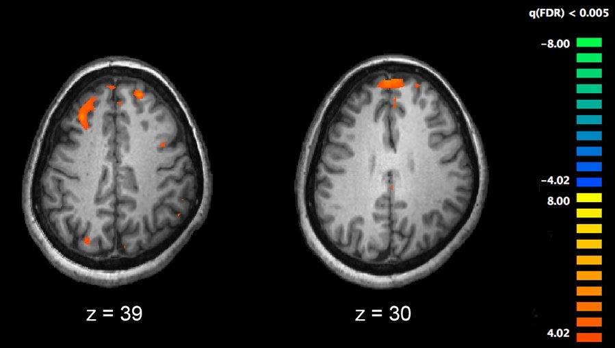 Probe of DNA repeats reveals genetic link to schizophrenia